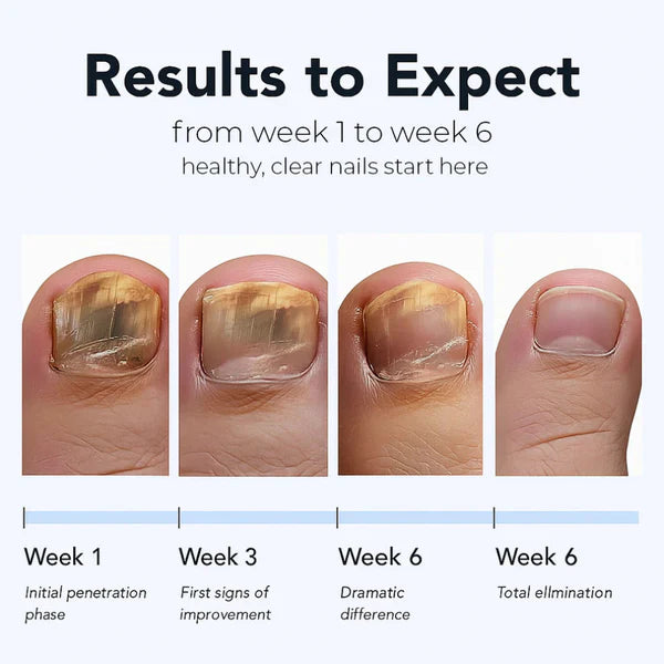 Clinex Fungal Nail Patches