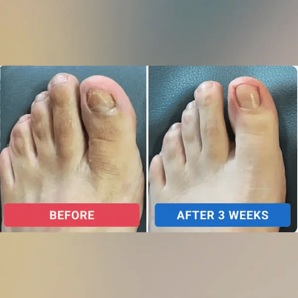 Clinex Fungal Nail Patches