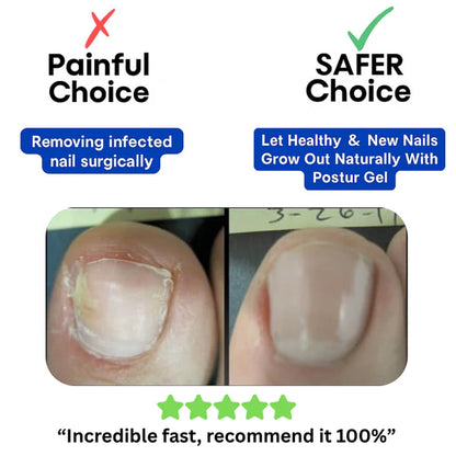 Clinex Fungal Nail Patches