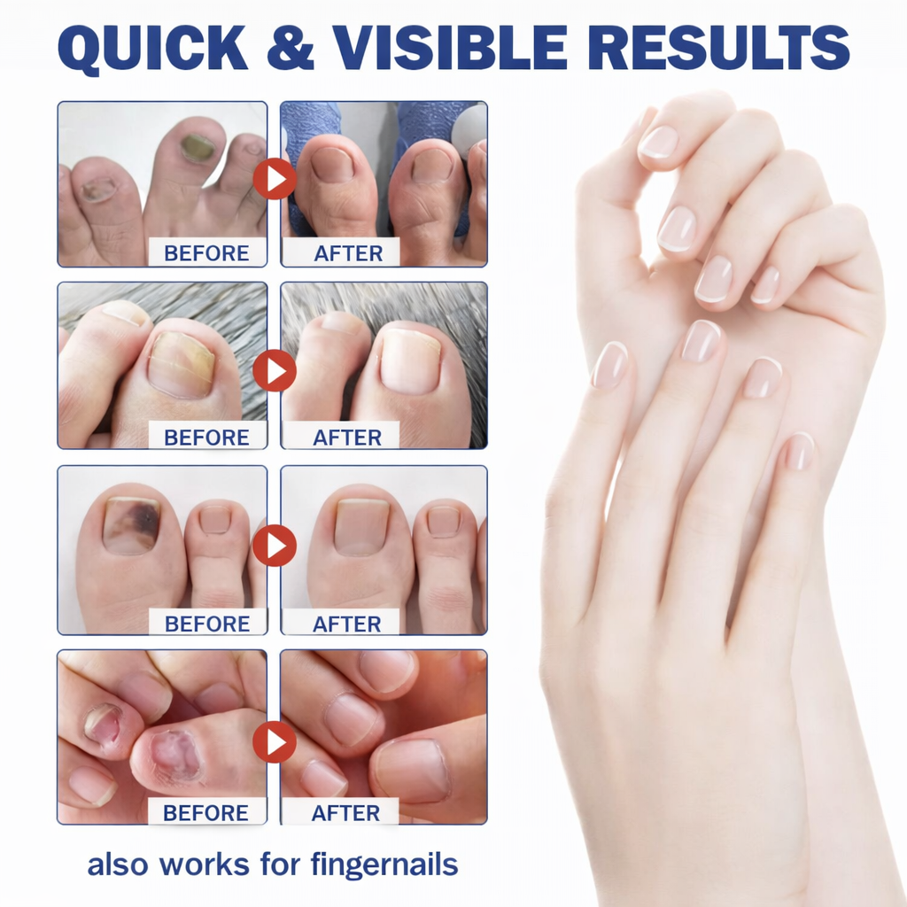Clinex Fungal Nail Patches