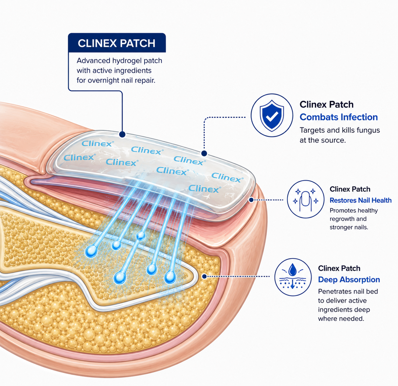 Clinex Fungal Nail Patches